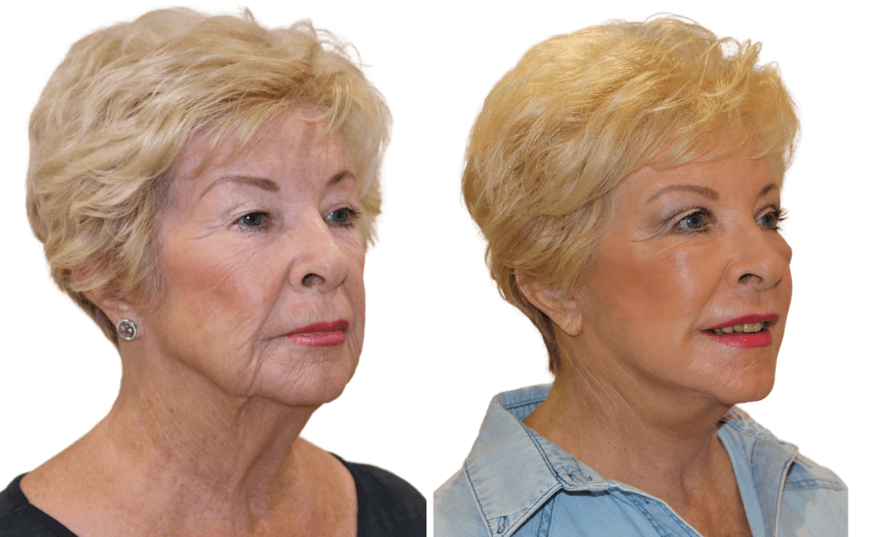 Before and after split image showing transformation with phenol peel