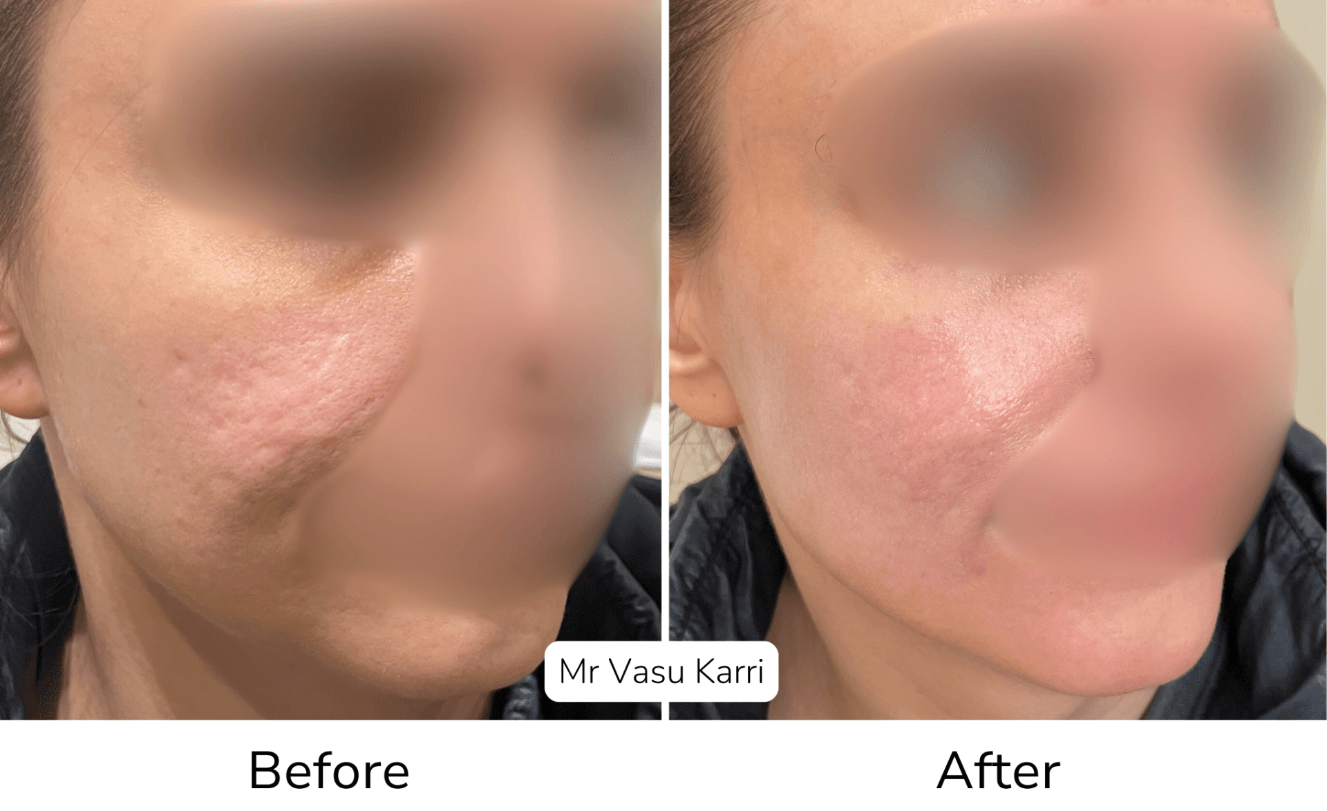 Phenol peel before and after showing acne scar reduction and skin texture improvement