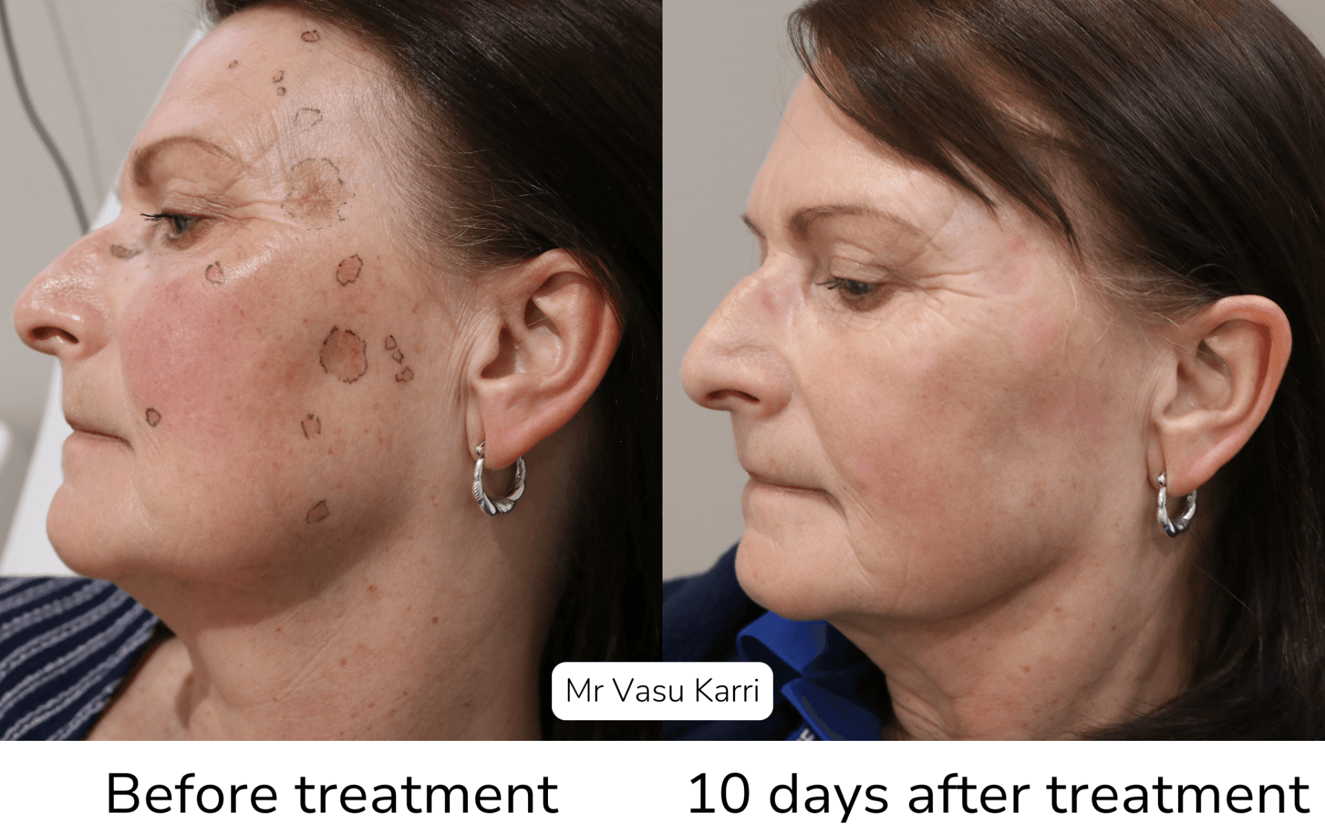 Phenol peel before and after showing brown age spot removal and pigmentation correction
