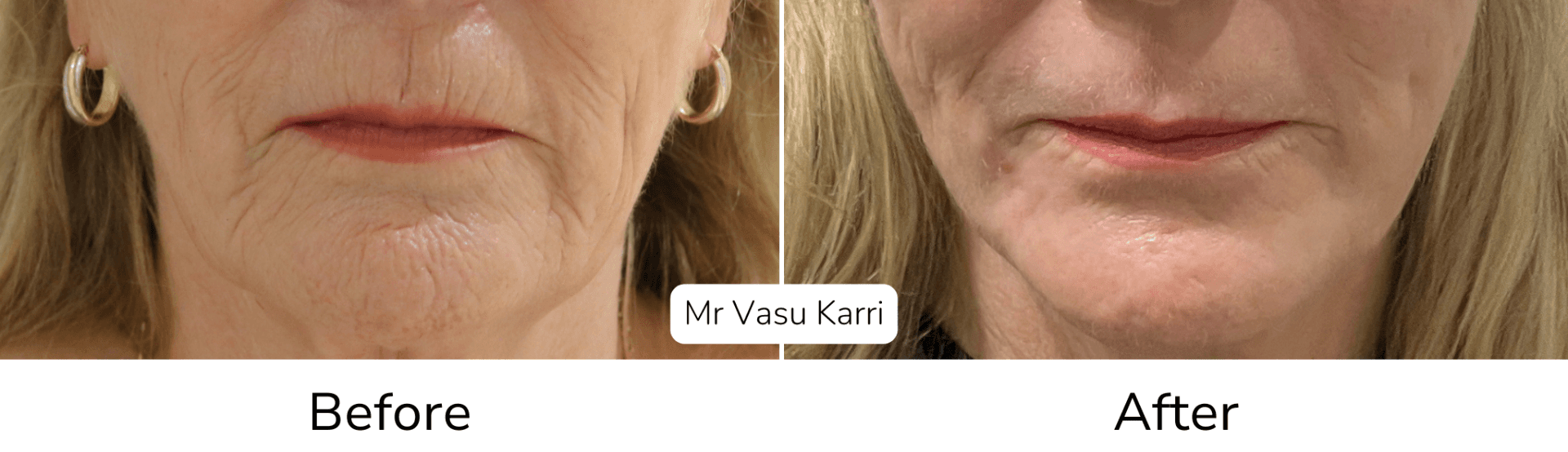 Phenol peel before and after showing perioral wrinkle reduction around the mouth