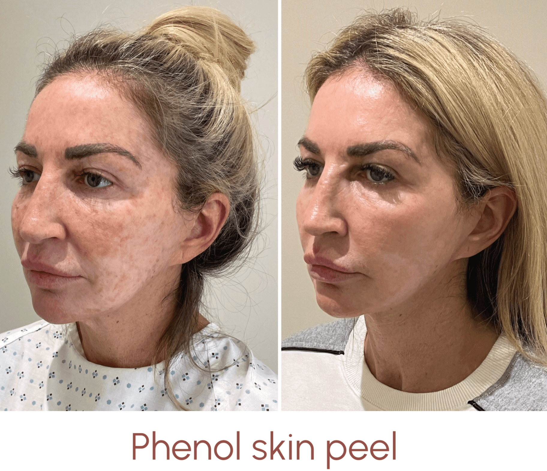 Before and after testimonial - phenol skin peel results