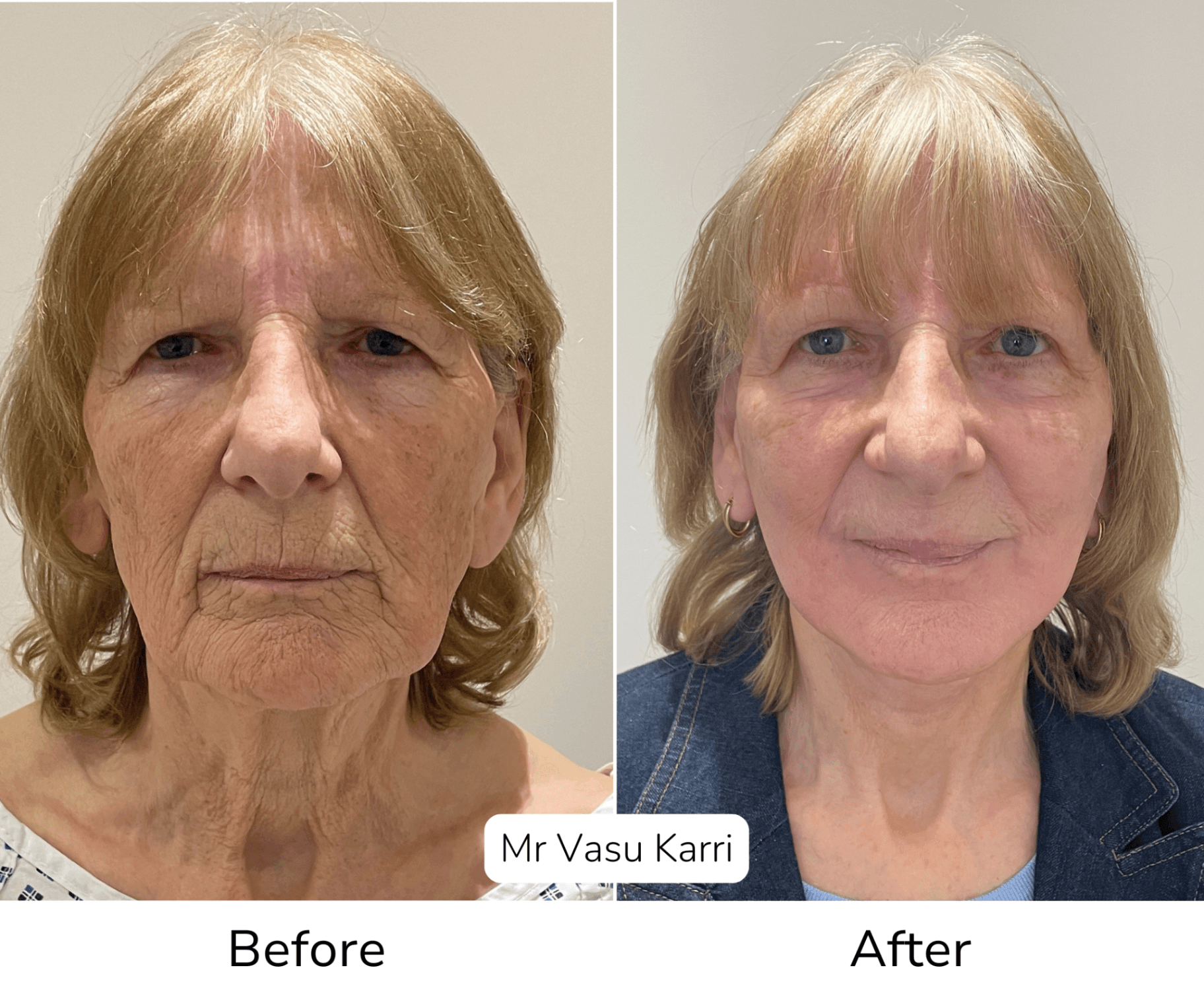 Phenol peel before and after combined with facelift showing facial rejuvenation results
