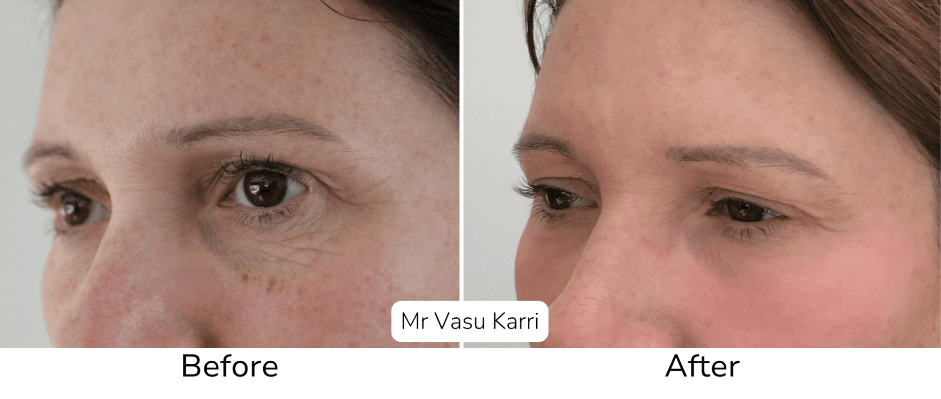 Lower eyelid wrinkles before and after treatment